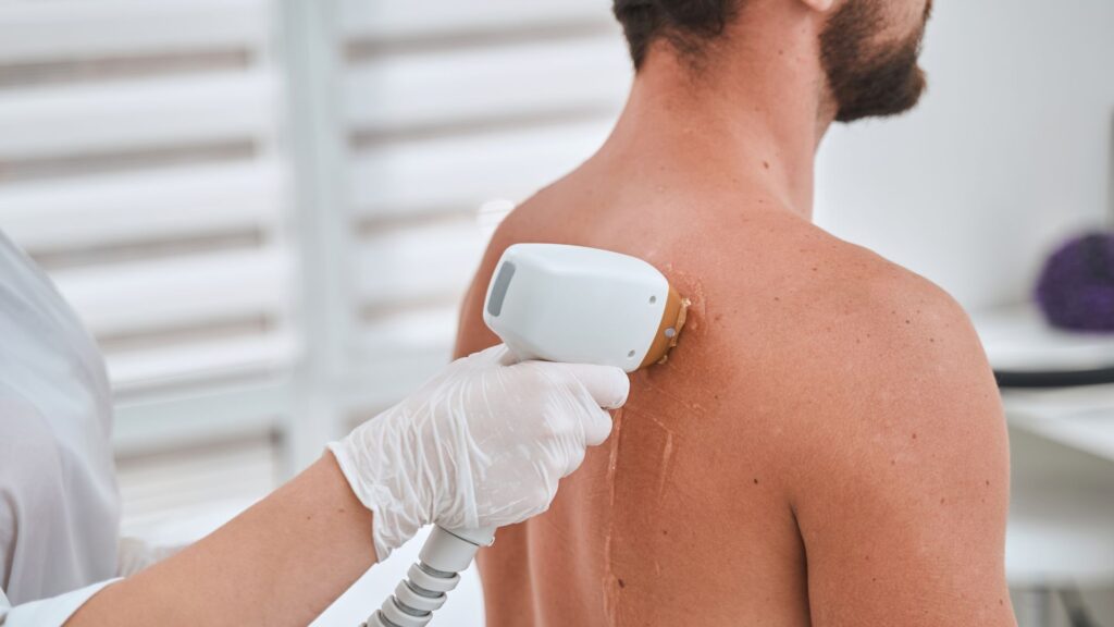 Profesional aplicando un tratamiento de depilación láser en la espalda de un hombre en un centro de depilación láser.