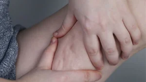 Celulitis visible en muslo siendo presionada para mostrar piel de naranja